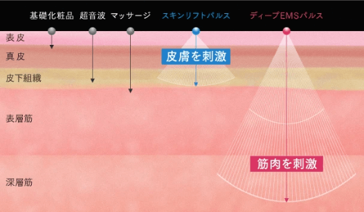 マイトレックスの高出力電気パルス